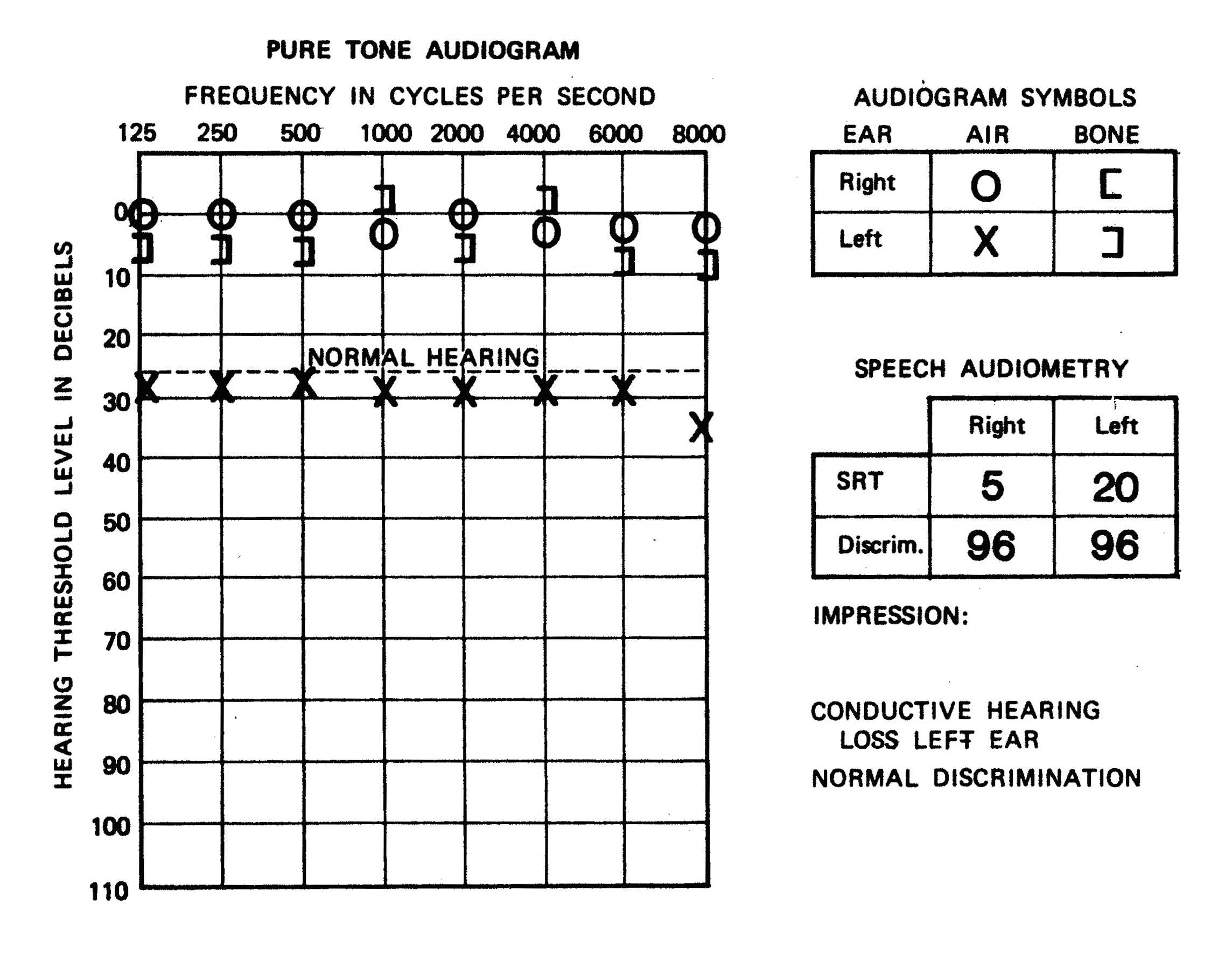 1000 Images About Audiology On Pinterest Pitch Cochlear Throughout Blank Audiogram Template Download