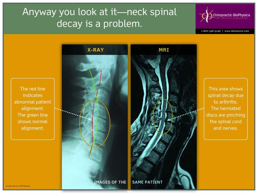 Neck Spinal Decay | Goodhealth Posters | Upper Cervical For Chiropractic X Ray Report Template