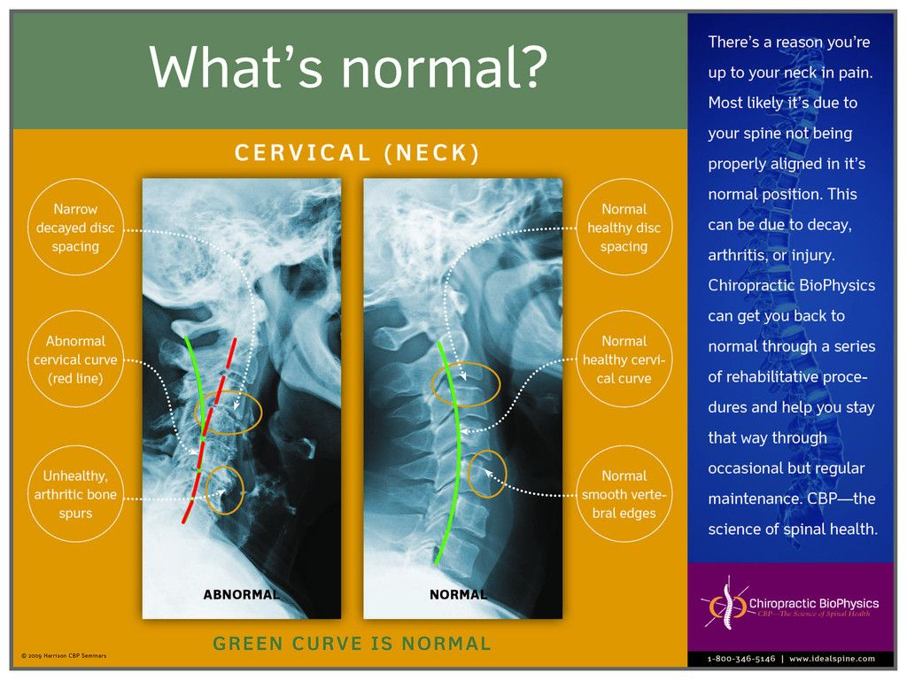 Normal Vs. Abnormal Cervical X Ray – Chiropractic Biophysics For Chiropractic X Ray Report Template